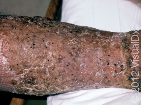 This image displays a severe case of stasis dermatitis (skin inflammation) due to poor circulation and chronic swelling.