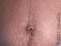 Stretch Marks (Striae)