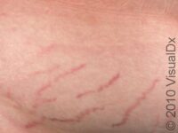 Stretch Marks (Striae)