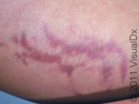Stretch Marks (Striae)