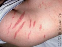 Stretch Marks (Striae)