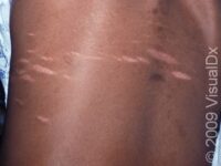 Stretch Marks (Striae)