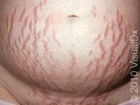 Stretch Marks of Pregnancy (Striae of Pregnancy) – Adult