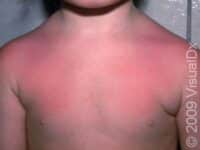 Sunburn