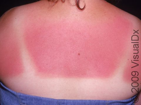 This image displays a patient with a sunburn.