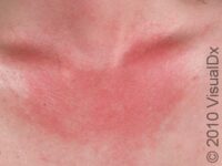 Sunburn
