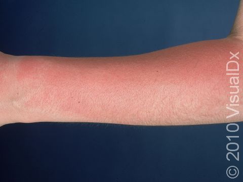 This image displays a sunburn.