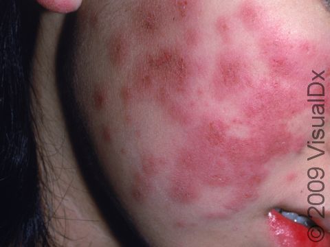 This image displays how inflammation in systemic lupus can be intense, causing very red skin lesions.