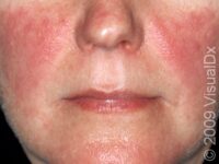 Systemic Lupus Erythematosus