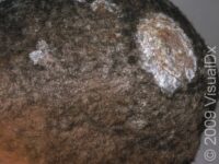 Ringworm, Scalp (Tinea Capitis)