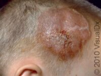 Ringworm, Scalp (Tinea Capitis)