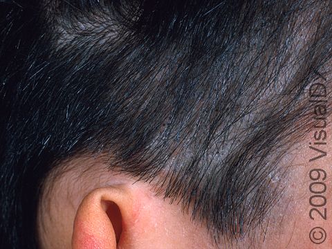 In a fungal infection of the scalp, there can be scaling without hair loss, as displayed in this image.