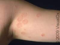 Ringworm (Tinea Corporis)