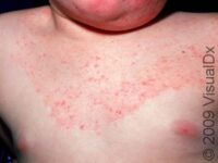 Ringworm (Tinea Corporis)