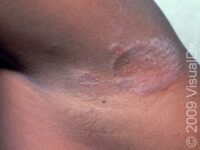 Ringworm (Tinea Corporis)