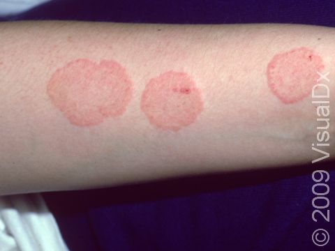 The round shape of tinea patches clearly reflects why it has the nickname ringworm. Note the slightly raised edge of the rings typical of tinea infections.