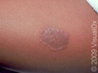 Ringworm (Tinea Corporis)