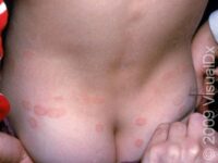 Ringworm (Tinea Corporis)