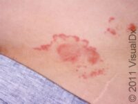 Ringworm (Tinea Corporis)