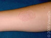 Ringworm (Tinea Corporis)