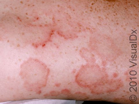 This image displays ring-like, red, scaly lesions that are slightly elevated, typical of tinea corporis (fungal skin infection).