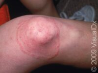 Ringworm (Tinea Corporis)