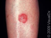 Ringworm (Tinea Corporis)