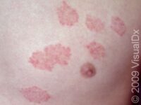 Ringworm (Tinea Corporis)