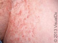 Jock Itch (Tinea Cruris)
