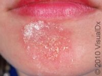 Ringworm, Facial (Tinea Faciei)