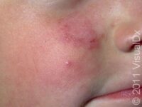 Ringworm, Facial (Tinea Faciei)