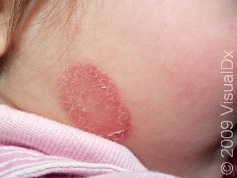 This image displays a classic occurrence of tinea faciei (ringworm) on the neck.