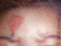 Ringworm, Facial (Tinea Faciei)