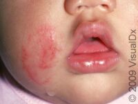 Ringworm, Facial (Tinea Faciei)