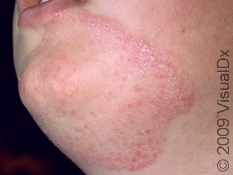 This image displays the superficial skin fungal infection of the face known as tinea faciei.