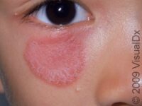 Ringworm, Facial (Tinea Faciei)