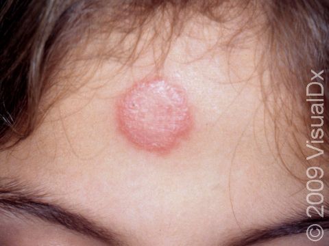 Tinea infection (ringworm) is characterized by a pink-to-red, round, scaling patch.