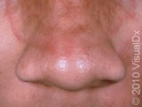 Ringworm, Facial (Tinea Faciei)