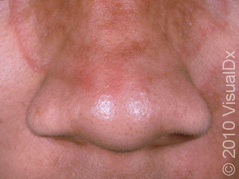 Tinea faciei, a fungal infection of the skin of the face, is displayed in this image as the arching red edge spanning from the cheek across the nose.