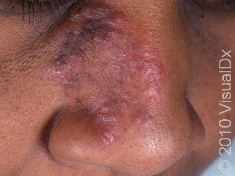 This image displays how tinea faciei (ringworm of the face) can present on darker skin.