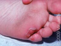 Athlete’s Foot (Tinea Pedis)