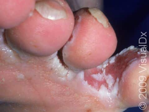 Moisture has been a prime factor encouraging athlete's foot infection between the toes displayed in this image.