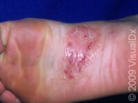 Athlete’s Foot (Tinea Pedis)