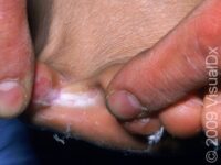 Athlete’s Foot (Tinea Pedis)