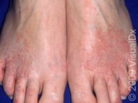 Athlete’s Foot (Tinea Pedis)