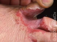 Athlete’s Foot (Tinea Pedis)