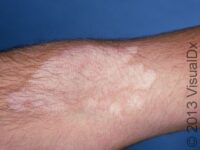 Tinea Versicolor