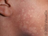 Tinea Versicolor