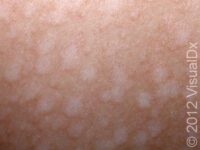 Tinea Versicolor