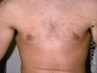 Tinea Versicolor